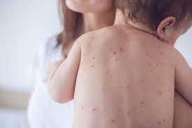 43 per cent increase in global measles deaths from 2021-2022: WHO