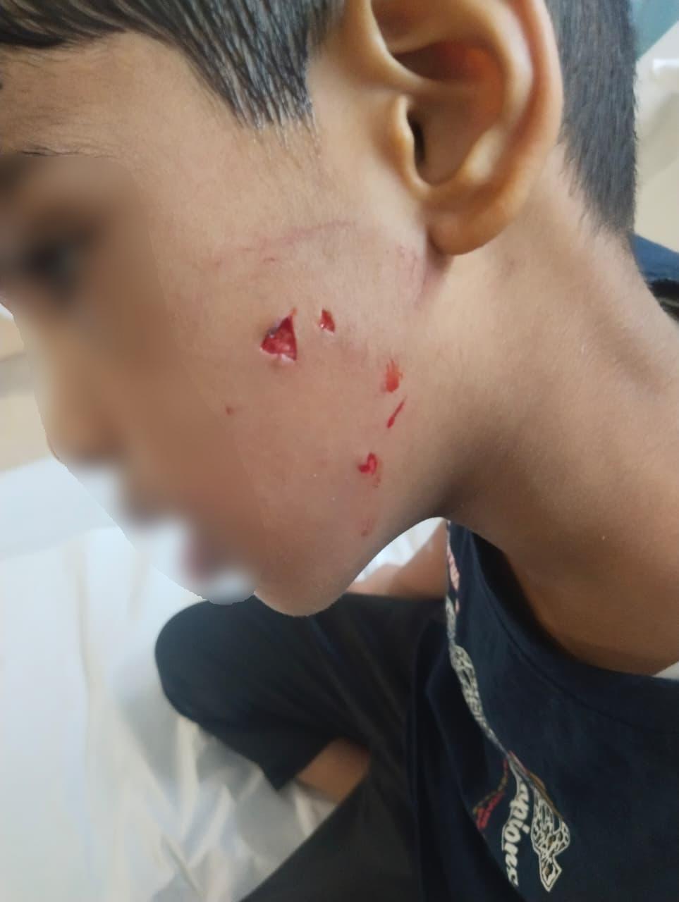 Mangalore: Six-year-old boy injured in stray dog attack in Bajpe